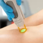 Épilation Laser